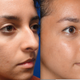 Illustration for article titled Rhinoplasty – What You Must Know About This Cosmetic Nose Procedure